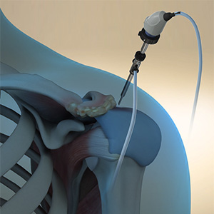 Benefits of Arthroscopic Surgery