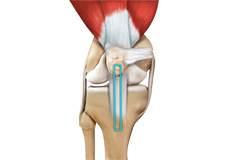 ACL Reconstruction with Patellar Tendon