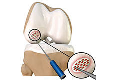 Arthroscopic Debridement