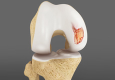 Articular Cartilage Injury