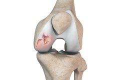 Chondral or Articular Cartilage Defects