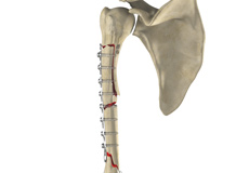 Complex Fractures