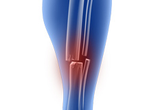 Fractures of the Tibia