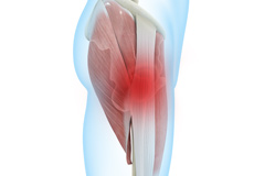 Greater Trochanteric Pain Syndrome