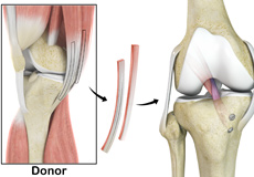 Hamstring Allograft