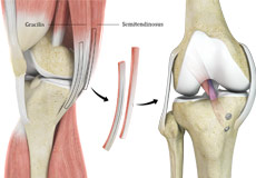 Hamstring Autograft