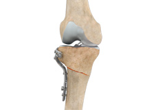 High Tibial Osteotomy