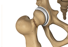 Hip Fracture