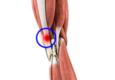 Iliotibial Band Syndrome