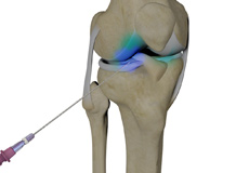 Intraarticluar Knee Injection