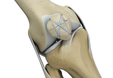 Knee Fracture Surgery