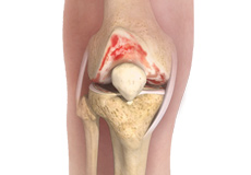 Knee Osteoarthritis