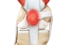 Kneecap Bursitis