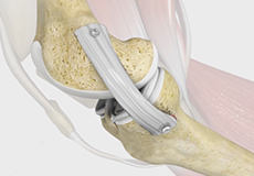 MCL Reconstruction