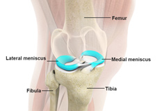 Medial Meniscus Syndrome