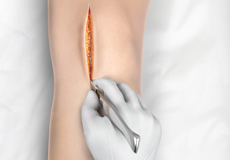 Minimally Invasive Knee Joint Replacement