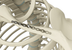 ORIF of the Clavicle Fractures