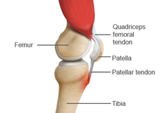 Osgood Schlatter Disease