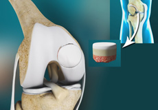 Osteochondral Defect of the Knee