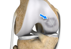 Osteochondritis Dissecans of the Knee