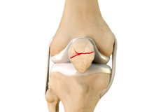 Fractures of the Patella