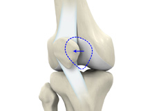 Patellar Dislocation/Patellofemoral Dislocation