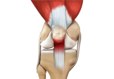 Patellar Tendinitis