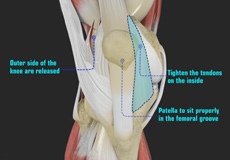 Patellofemoral Realignment