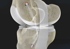 Posterolateral Corner (PLC) Reconstruction