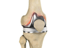 Periprosthetic Knee Infection