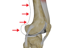 Posterolateral Instability