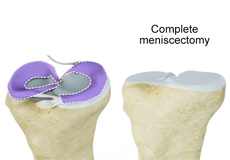 Prior Meniscectomy