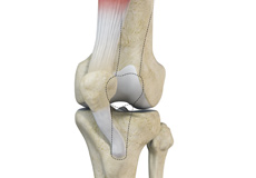 Recurrent Patella Dislocation