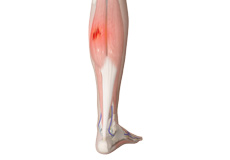 Medial Gastrocnemius Strain
