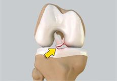 Tibial Eminence Fractures