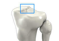 Tibial Eminence Spine Avulsion Fracture