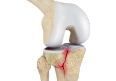 Tibial Plateau Fracture