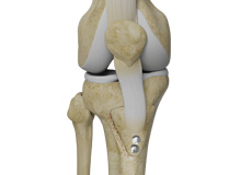 Tibial Tubercle Transfer