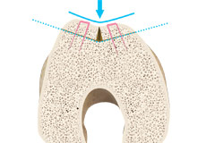 Trochleoplasty